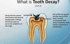 Pin On Fillings And Root Canals