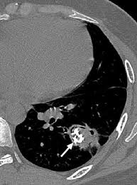 Image result for Broncholithiasis