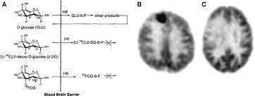 Retrospective pet study and animal experiment. Gallagher S Principle Of Metabolic Trapping Perspective On Metabolic Trapping As A Principle Of Radiopharmaceutical Design Some Factors Responsible For Biodistribution Of 18f 2 Deoxy 2 Fluoro D Glucose J Nucl Med 1978 19 1154 1161 Journal Of