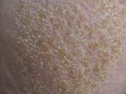 This scalp irritation is similar to dandruff. Newborn Baby Dry Skin Scalp Newborn Baby