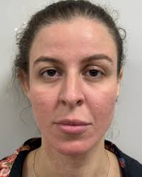 Bella, eu só tiro foto do lado que minha mandíbula é marcada, odeio essa  assimetria!” Revolvido! ✓ E trabalhamos em toda face trazendo lifting,  descanso, novas projeções e uma autoconfiança enorme! 10ml