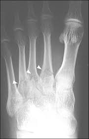 Hi i'm a middle/short distance track and field runner and i have recently fractured my second metatarsal. Diagnosis And Management Of Metatarsal Fractures American Family Physician
