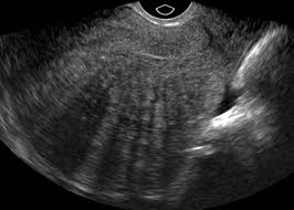 Adenomyosis (or uterine adenomyosis) is a common uterine condition of ectopic endometrial tissue in the classically, adenomyosis most commonly affects multiparous women of reproductive age. Adenomyosis A Sonographic Diagnosis Radiographics