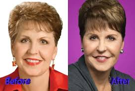 Joyce Meyer Plastic Surgery