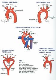 Right Sided Aortic Arch Nursing Study Respiratory Therapy Pediatrics