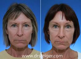 Brow lifts are by no means the new kid on the cosmetic procedure block—people have been getting them for decades. Forehead Lift Before And After Photos