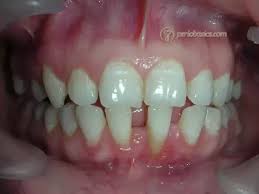 Deep cleans mouth, between teeth, and along the gum line to gently remove stains & plaque. What Causes Brown Color Stain In Between Teeth In The Gum How Can I Get Rid Of It Quora
