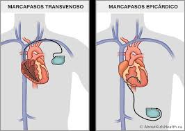 Un marcapasos artificial es un dispositivo electrónico que envía impulsos al corazón para que mantenga el ritmo normal. Marcapasos El Cuidado De Su Nino En Casa