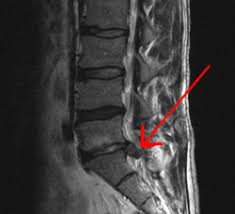 Most people are back under the knife again within a year. Spinal Disc Herniation Wikipedia