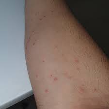 Image result for bedbugs bites