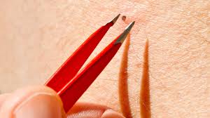 However, there is one thing you try: This Viral Video Of A Six Year Old Ingrown Hair Being Removed Is Frightening Allure