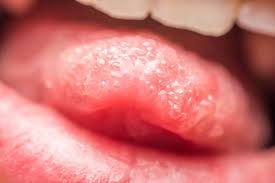Our powerful toothpaste collection helps reverse early gum damage. Strawberry Tongue The Symptom And Its Various Causes Explored