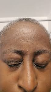 I suddenly have a large, soft lump directly below my knee. It isn't hot.  Not painful. Fluid maybe? I did pop my knee pretty painfully yesterday