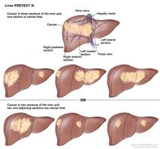 Childhood Liver Cancer Treatment Pdq Treatment Health