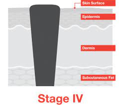 The stage of skin cancer upon diagnosis plays a large role in survival, and some studies have suggested there is a difference in how likely the cancer is to have spread at diagnosis based on the. Stage 4 Melanoma Melanoma Research Alliance