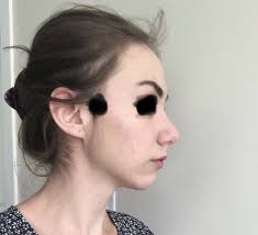 Can frontal bossing be fixed with fillers? (Photo)