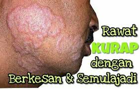 Ketika merawat anak kucing dari kecil dan tanpa induk memang memerlukan ketekunan selama beberapa bulan pertama. Cara Merawat Kurap Dengan Berkesan Dan Semulajadi Serimuslimah Sihat