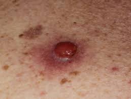 9 zeilen · 23.05.2020 · hereditary breast and ovarian cancer syndrome (hboc) refers to mutations … Genetics Of Melanoma Dermnet Nz
