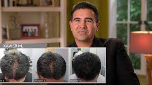 But can hair loss after surgery occur ? How You Can Stop Hair Loss And Regrow What You Lost Without Surgery
