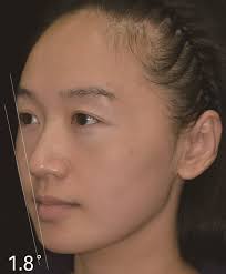 Buccal Fat Pad Augmentation for Midfacial Rejuvenation: Modified Fat  Grafting Technique and Ogee Line Remodeling