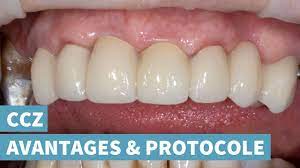 We did not find results for: Couronne Ceramo Ceramique Zircone Avantages Protocole Youtube