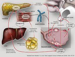 Understanding Polycystic Ovary Syndrome Bpj 12 April 2008