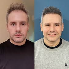 Injerto Capilar Barcelona