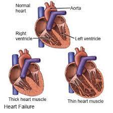 Unfortunately, there is no cure for congestive heart failure. Heart Failure Discharge Care What You Need To Know