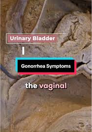 Image result for gonorrhea symptoms