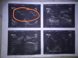 Dinding kandung empedu tergambar sebagai struktur hiperechoic yang menhelilingi kandung empedu. Batu Empedu Batu Empedu