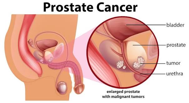 Prostatectomy
