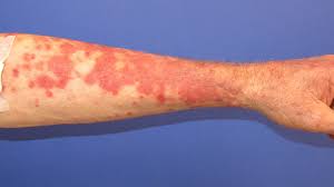 Image result for Pemphigus
