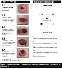 content validation of a standardized algorithm for ostomy