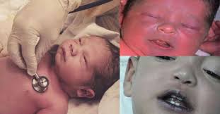 ⭕️ The chloramphenicol-induced ( gray baby syndrome) The rate of  chloramphenicol metabolism was found to be highly age dependent and the  half-life was 26 hours in the newborns, 10 hours in infants,