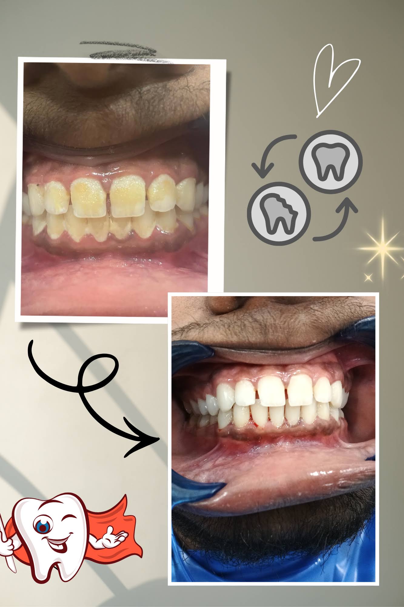 Teeth cleaning product image