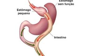 cirurgia bariatrica e eficaz no controle do diabetes tipo 2 cirurgia bariatrica bariatrica cirurgia bariatrica bypass