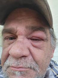 Beekeeping experiences and safety precautions