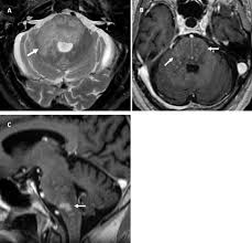 The appearance of clippers on mri is fairly unique, characterized by multiple punctate, patchy and linear regions of contrast enhancement relatively confined to the pons 1 clippers syndrome. Chronic Lymphocytic Infiltration With Pontine Perivascular Enhancement Responsive To Steroids Clippers And Its Association With Epstein Barr Virus Ebv Related Lymphomatoid Granulomatosis A Case Report Bmc Neurology Full Text
