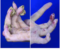 A dry, dark scab or scar, especially as a result of burning. Fingers With Accumulative Eschar On Left And With Eschar Just Been Download Scientific Diagram