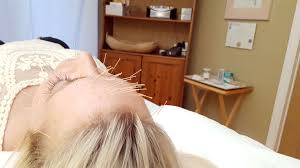 Cosmetic Facial Rejuvenation Acupuncture Ottawa Harmony Acupuncture