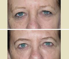 Laser Eye Tightening Gallery