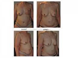 Deciding whether to have breast reconstruction. Reconstruction Mammaire Par Lambeau Abdominal Diep A Grenoble Dr Hamou