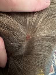 Image result for white scabs on the head in children