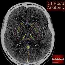 Axial Slice Of A Non Contrast Ct Head At The Level Of The Basal Ganglia The Basal Ganglia Are A Group Radiology Student Radiology Diagnostic Imaging