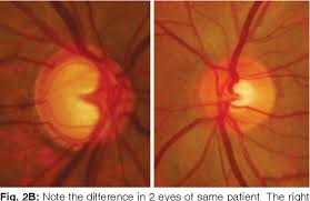 The head, neck and torso of the human body are connected to the brain via the brainstem through a network of 12 cranial nerves. Figure 2 From Evaluation Of The Optic Nerve Head In Glaucoma Semantic Scholar
