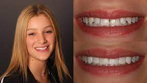 This is why we have launched a concierge service to help our patients with their cosmetic needs such as: Best Cosmetic Dentist Cb Smiles