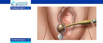 What Is Marsupialization?|Marsupialization Of Bartholin Cyst| Iranian  Surgery