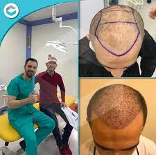 Hastamizin Sac Ekimi Isleminden Sonraki 10 Gunluk Degisimi Clinista Ile Mutlu Hastalar Detayli Bilgi Icin Lutfen Iletisime G Hair Transplant Hair Hairstyle