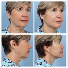 Where Facial Rejuvenation Begins Beneath the Surface