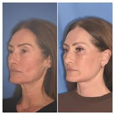 Feeling great and looking great! This wonderful patient couldn't be  happier, and we love sharing in her excitement! 4 week result after: Deep  plane facelift and necklift Revision upper blepharoplasty Lower  blepharoplasty